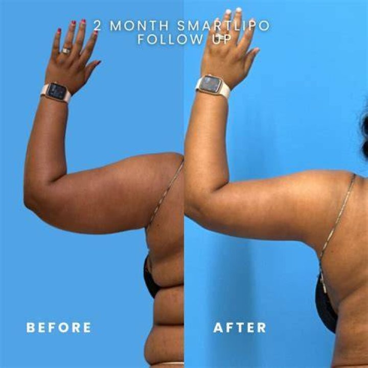 
Blessing CEO: Why I Opened Up About My Liposuction 