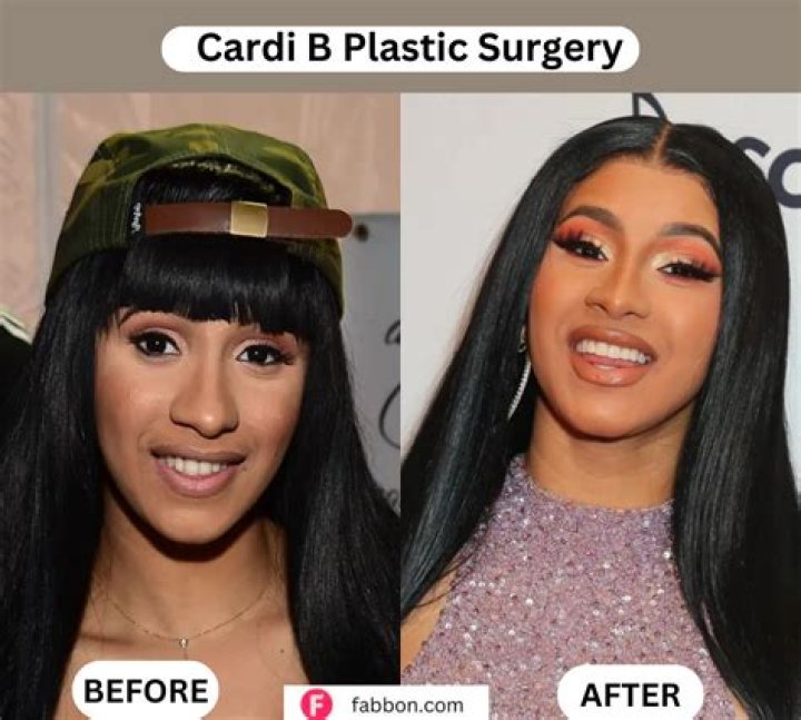 Cardi B Video Plastic Surgery
